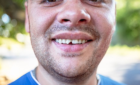 a person smiling showing a chipped tooth