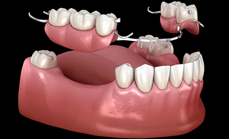 a computer illustration of partial dentures