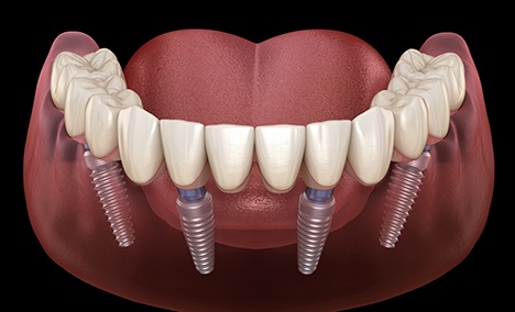 a computer illustration of implant dentures